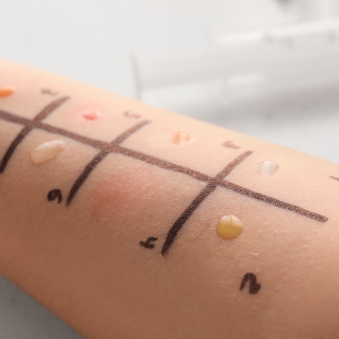 Allergy testing on arm