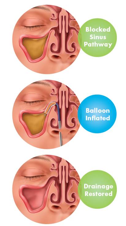 Your Southfield and Allen Park sinus doctors will go through a balloon sinus dilation in three steps.