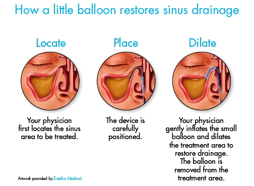 Balloon sinus dilation is an effective way to restore draining to your sinuses.