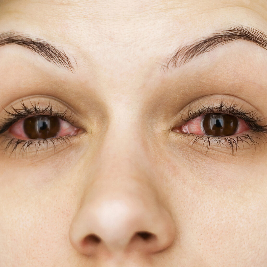 Image of a woman with red itchy eyes