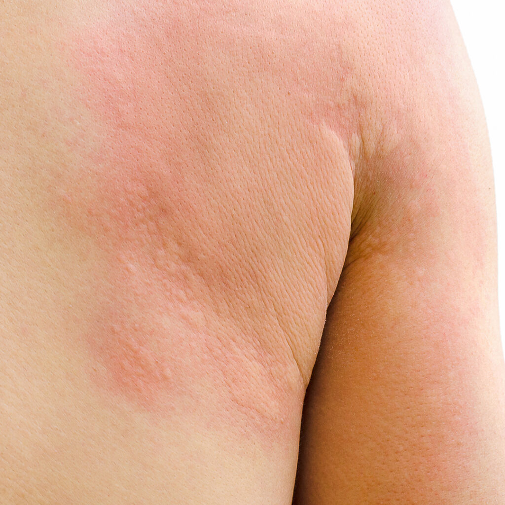 Image of a person with hives