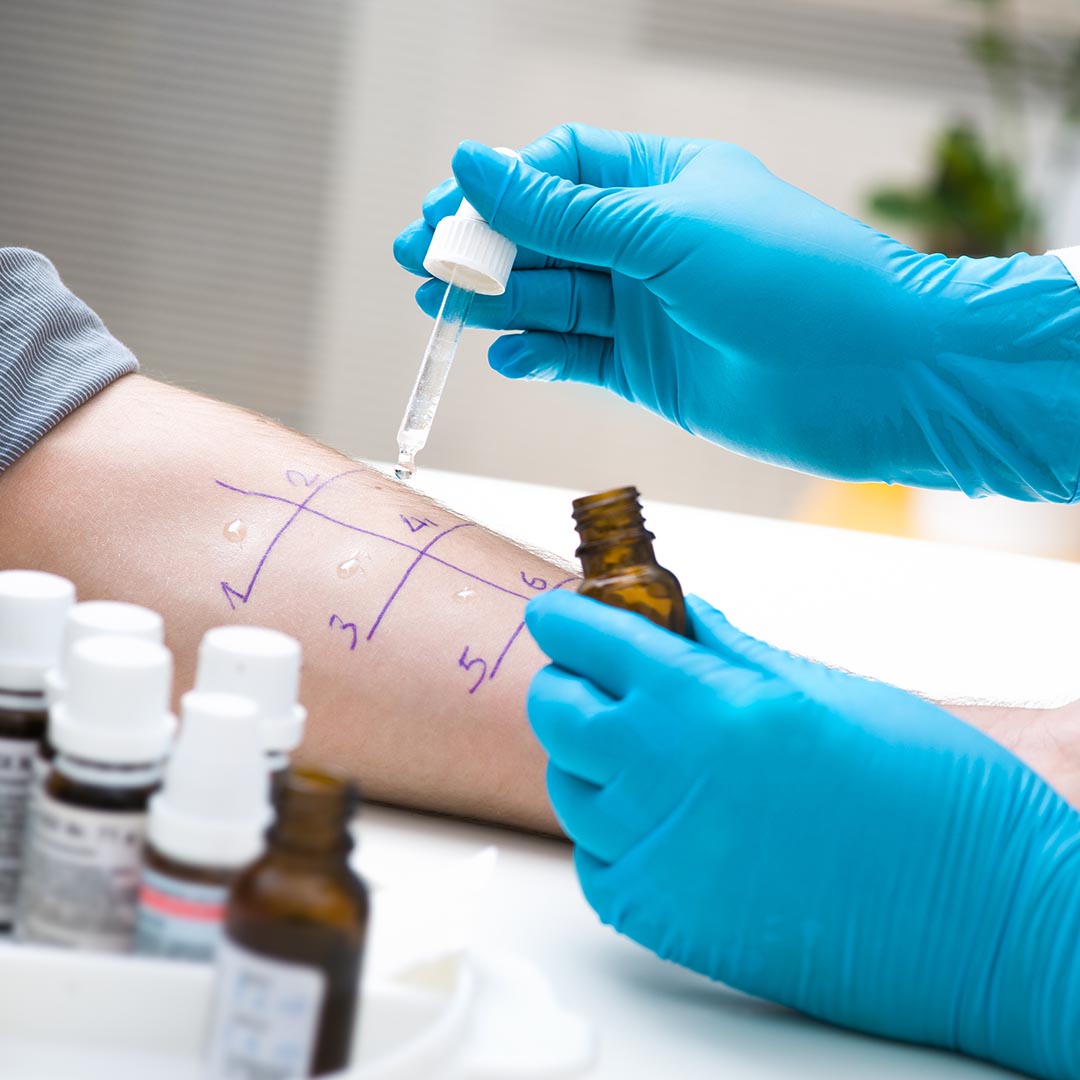 Doctor performing allergy test on man's arm