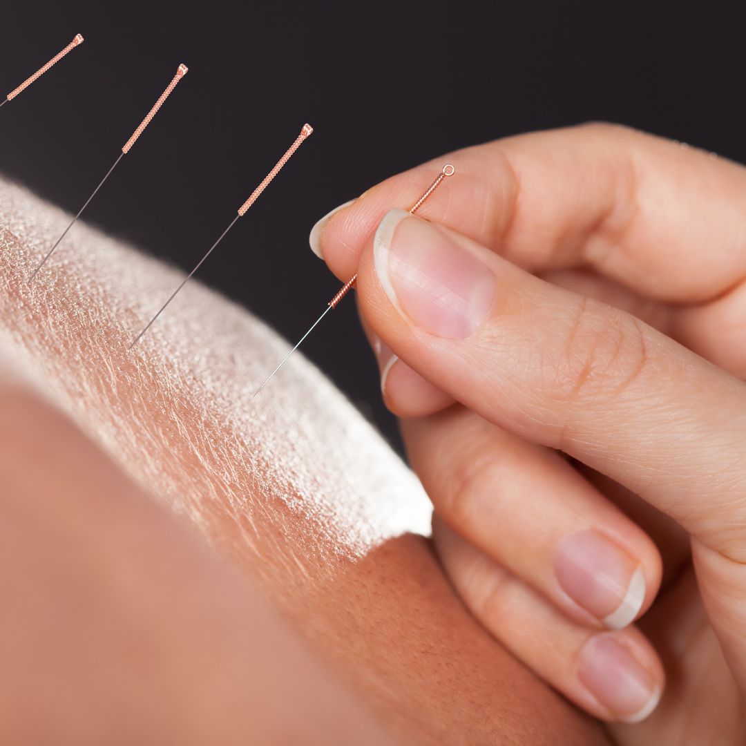 acupuncture needles in skin